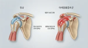 회전근개 파열